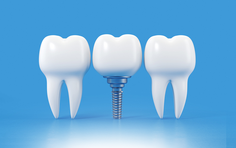 Dental implants benefits explained by Greenwood Park Dentistry