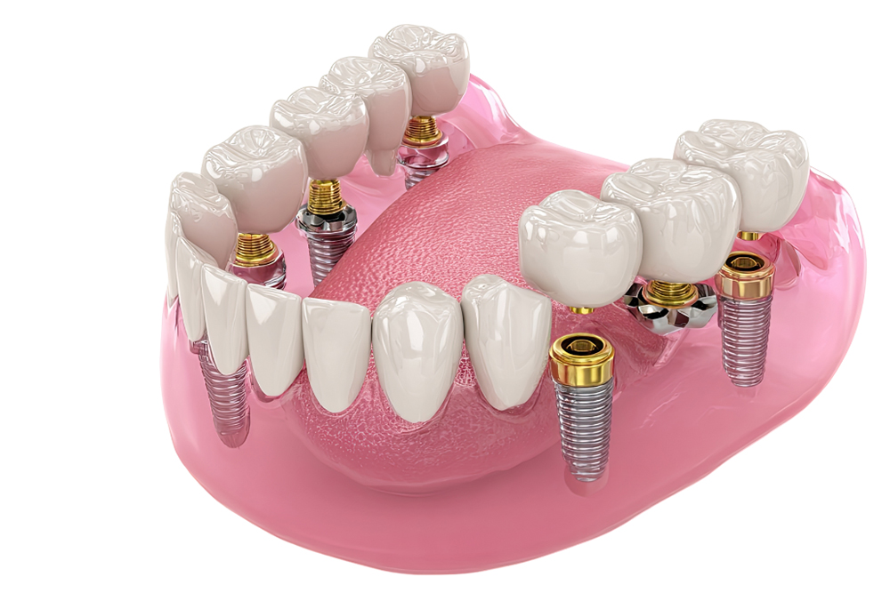 All on X upper vs lower jaw treatment differences at Greenwood Park Dentistry Kingston