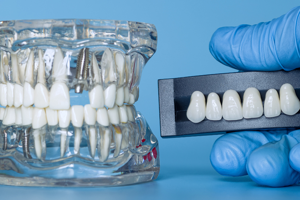 Implant specialist front teeth aesthetic results at Greenwood Park Dentistry Kingston